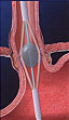 The catheter is placed through the mouth and into the valve between the stomach and the esophagus. 