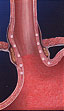 The Physician then delivers safe, controlled levels of radio frequency (RF) energy to the LES muscle and the gastric cardia (uppermost part of the stomach) to create thermal lesions