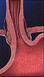 When the lesions heal, the barrier function of the LES is improved reducing the frequency and severity of reflux