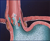 GERD (Gastroesophageal reflux disease) occurs when stomach acid, enzymes, and bile "reflux" upward from the stomach into the esophagus through the lower esophageal sphincter. The most common symptom associated with GERD is heartburn.